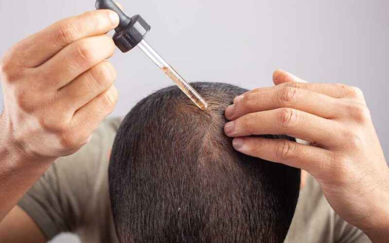 Quem tem mais efeitos colaterais: finasterida ou minoxidil