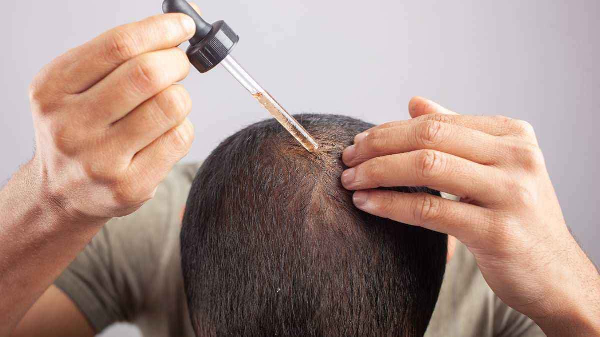 Quem tem mais efeitos colaterais: finasterida ou minoxidil?