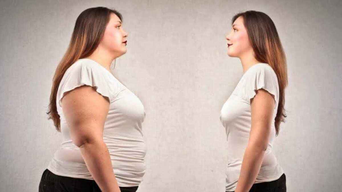 Chega de efeito sanfona! A cirurgia bariátrica pelo convênio pode ser a solução