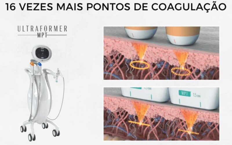 Como o Ultraformer MPT redefine resultados e transforma negócios