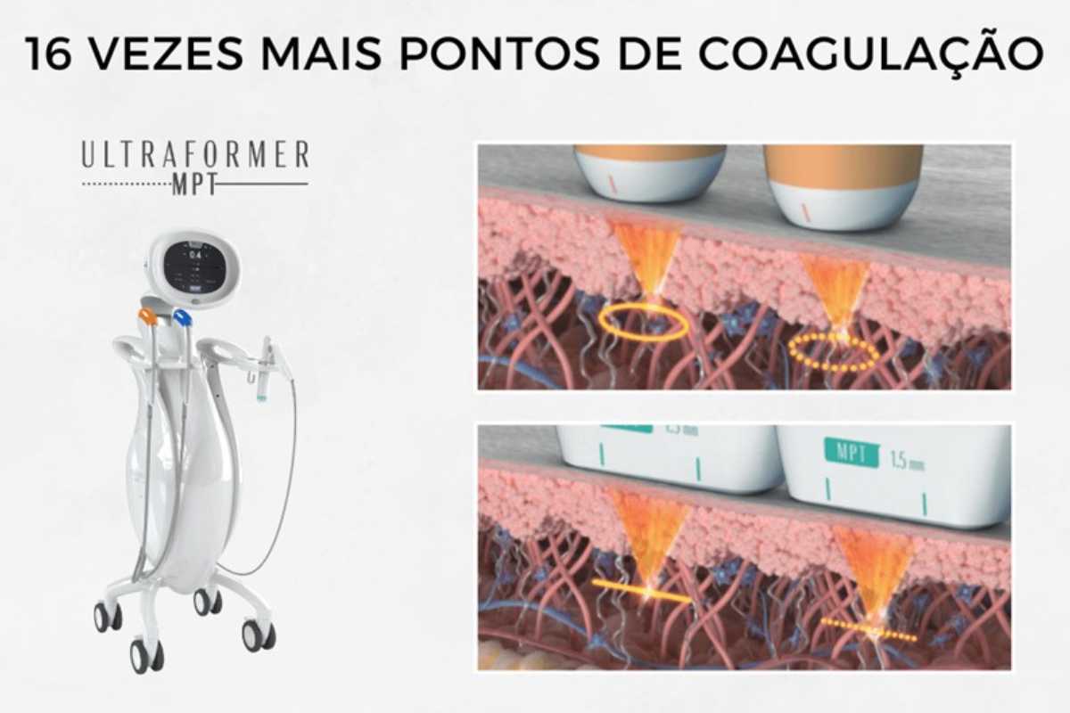 Como o Ultraformer MPT redefine resultados e transforma negócios